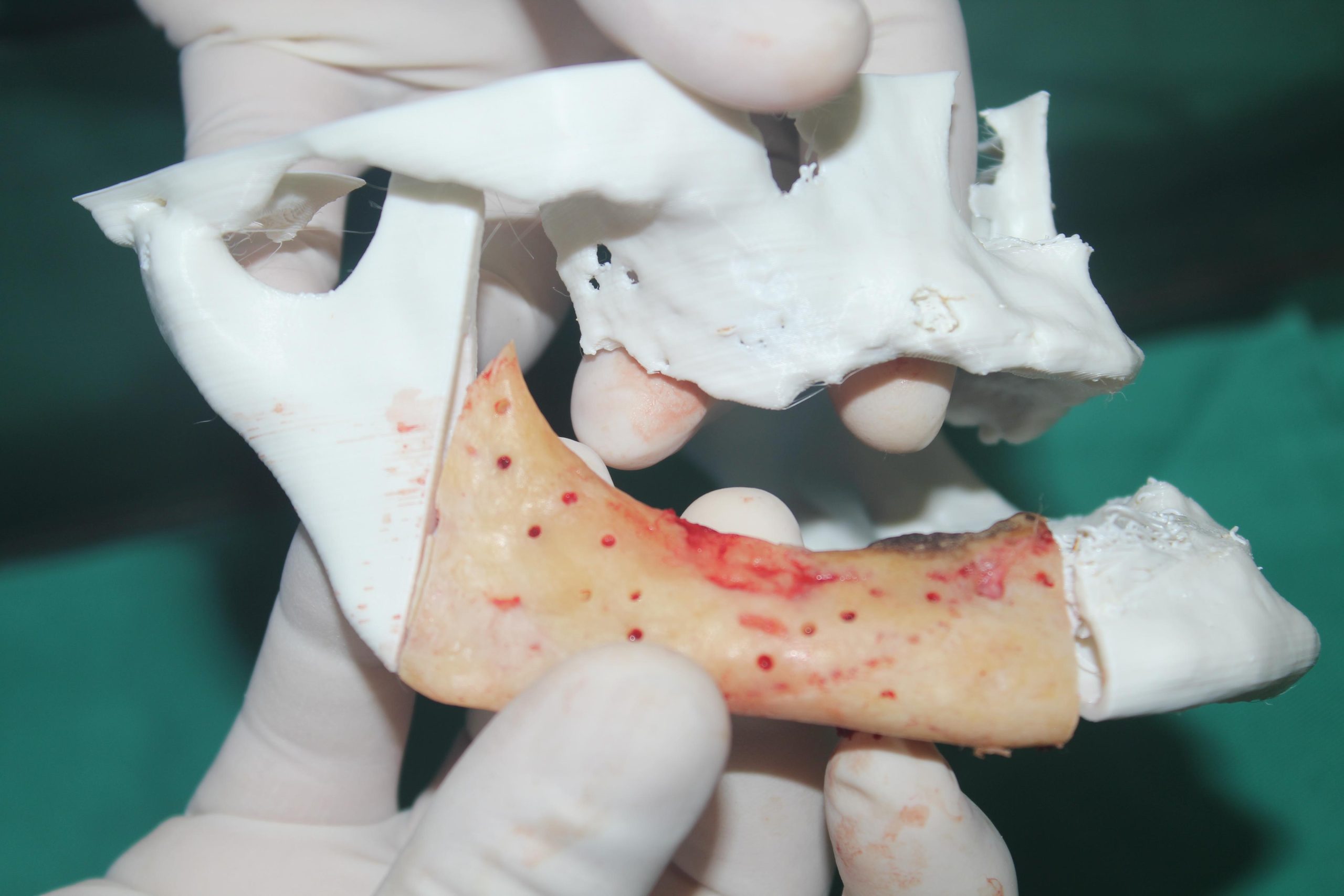A equipe de cirurgia bucomaxilofacial do Hospital Ophir Loyola, utilizou uma tomografia computadorizada para fazer um planejamento cirúrgico 3D e gerar um protótipo 3D, em tamanho real da região afetada da face, com simulação virtual da operação.